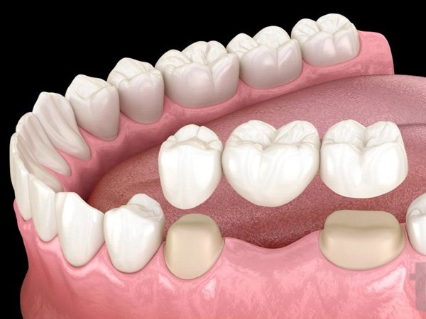 Fixed prosthodontics
